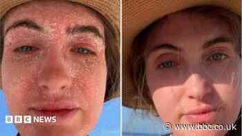 'My skin condition made me look like I was in a horror movie'