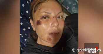 ASIRT looking into Edmonton woman’s allegation of unprovoked police assault: ‘Smashed my face’