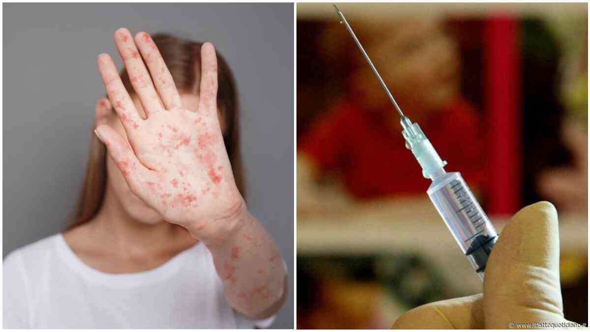 “Ridurre le vaccinazioni contro il morbillo può aprire la strada a epidemie molto estese”, l’infettivologo e lo studio Usa sul rischio di decessi pediatrici