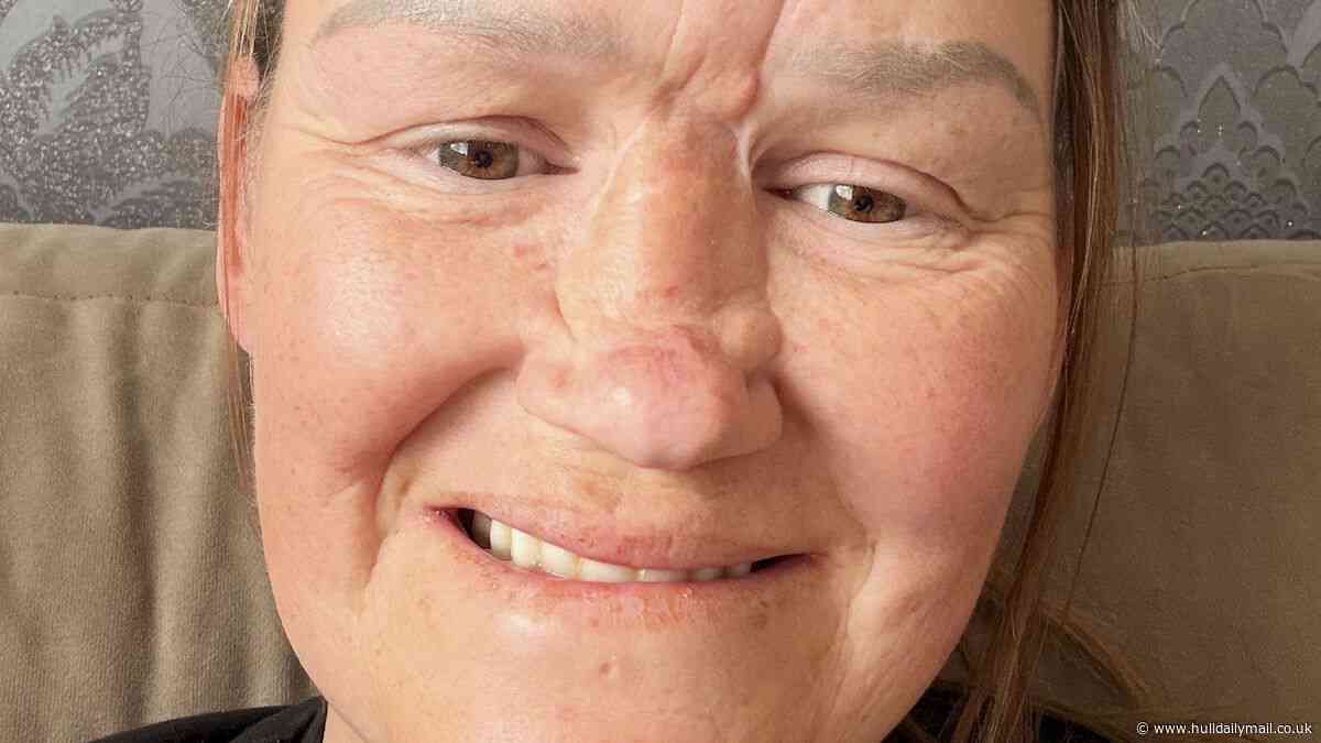 'I jumped into the sea on holiday and lost most of my nose - I looked like a monster'