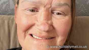 'I jumped into the sea on holiday and lost most of my nose - I looked like a monster'