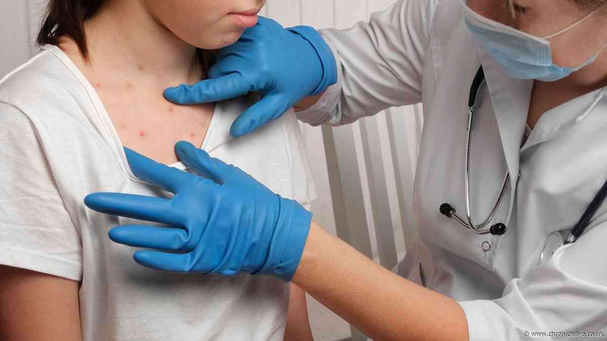NHS list of Hepatitis A symptoms after cases confirmed at Newcastle primary schools