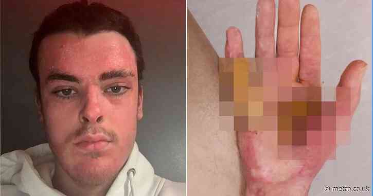 Apprentice welder wins six-figure payout after ‘human fireball’ work accident