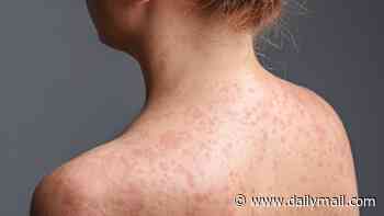 Urgent measles warning for Sydney after infected patient visits popular spots including Kmart