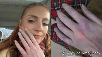 Beth thought her cold hands were just a quirk or harmless Raynaud's... but they were actually the first sign of an autoimmune condition that can be life-threatening. So many cases are being missed