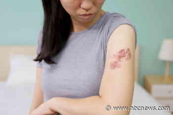 Shingles plummets among younger adults but is mysteriously rising in another group
