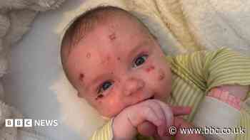I was told my baby boy's skin was as fragile as glass