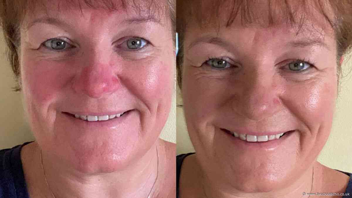 Woman with rosacea 'felt a million dollars at niece's wedding' with £25 cream