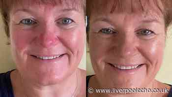 Woman with rosacea 'felt a million dollars at niece's wedding' with £25 cream