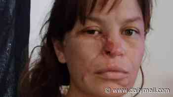 Woman disfigured by pit bull attack while heavily pregnant with twins says she is distressed by strangers' constant stares