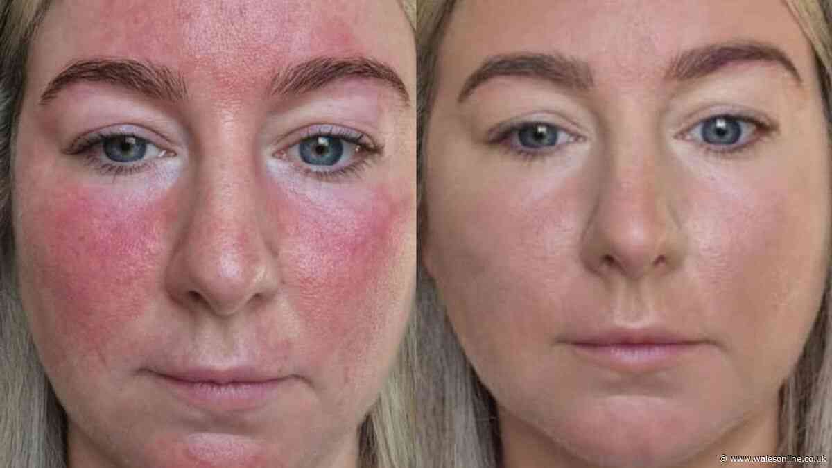 'I can't thank you enough, my redness has disappeared' as cream slashed to £25