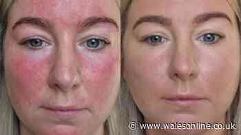 'I can't thank you enough, my redness has disappeared' as cream slashed to £25