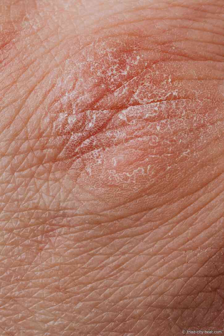 How the Season Change Sneaks Up on Your Skin