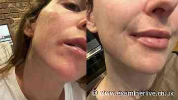 Woman's cold sores 'ruined wedding kiss' but £10 balm stopped outbreaks for a year