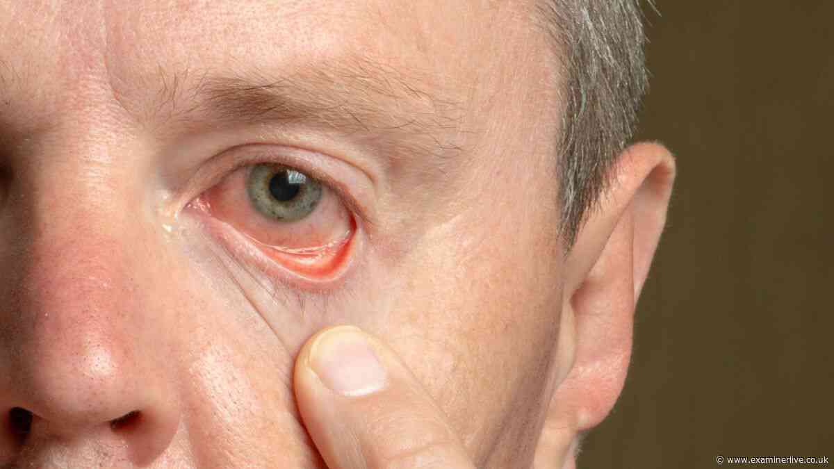 DWP confirms full list of 45 eye conditions that qualify for £114 weekly PIP payment