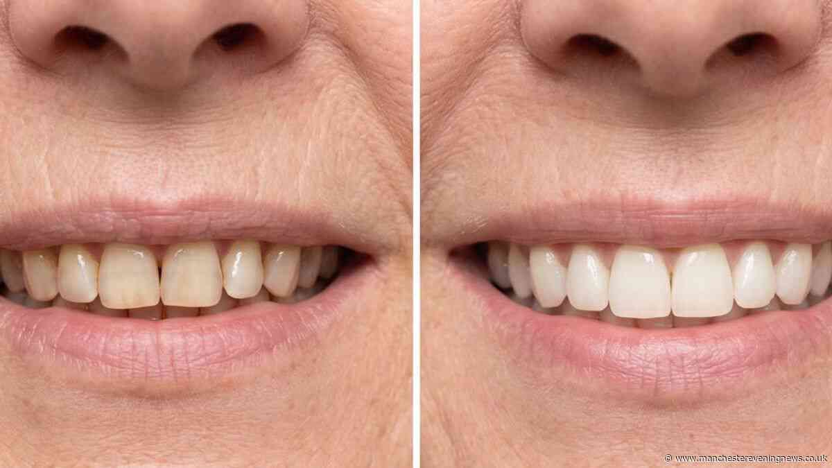 Tea drinker's yellow teeth now 'much whiter after first go' using 32p-a-use fix