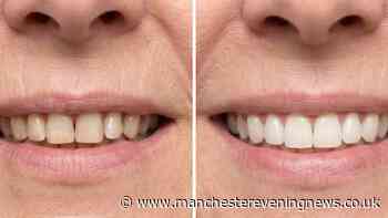 Tea drinker's yellow teeth now 'much whiter after first go' using 32p-a-use fix