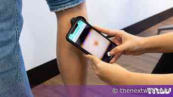 NHS South East rolls out skin cancer AI that can discharge patients alone