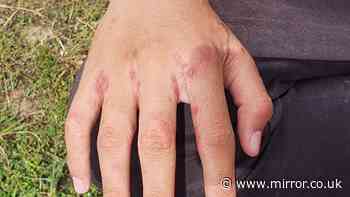 Hospital wards forced to close after Victorian disease scabies outbreak spreads across country