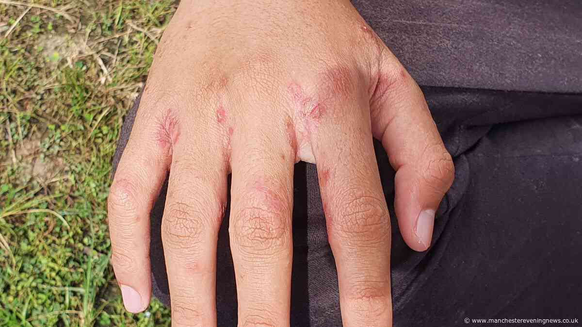 Hospital wards forced to close down amid scabies outbreak