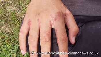 Hospital wards forced to close down amid scabies outbreak