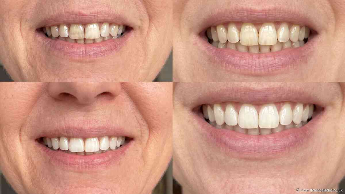 Woman's 'family commented on how great my teeth looked over dinner' after £18 buy