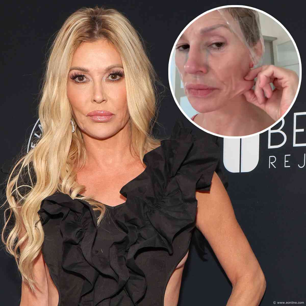 Brandi Glanville Getting Surgery to Find Out What's "Eating" Her Face