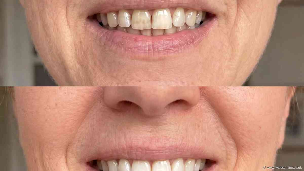 Woman 'removes years of tea stained teeth' with £18 buy even 'family noticed'