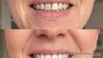 Woman 'removes years of tea stained teeth' with £18 buy even 'family noticed'