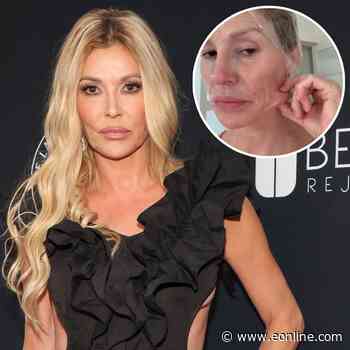 Brandi Glanville Getting Surgery to Find Out What's "Eating" Her Face