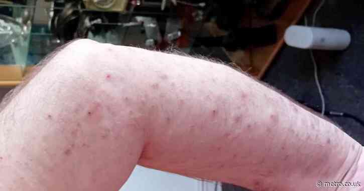 Man left with 1,000 bedbug bites following repeated infestations