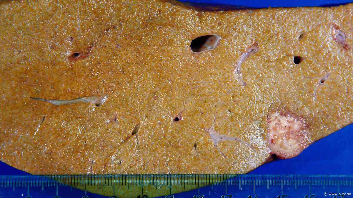 Übergewicht, Diabetes, Alkohol: Immer mehr junge Menschen haben eine Fettleber