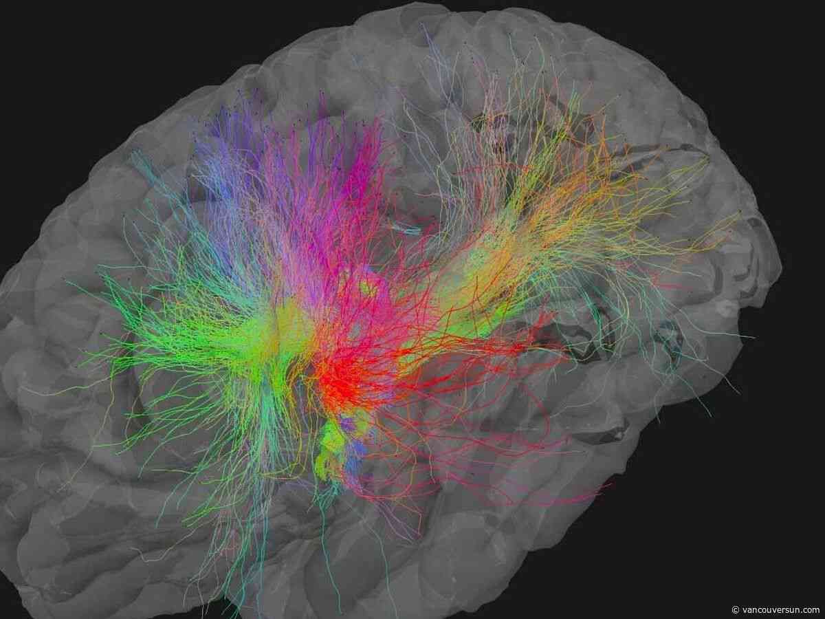 Brain project at SFU aims to discover why some people don't get dementia, despite risk factors