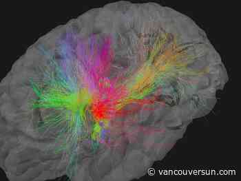 Brain project at SFU aims to discover why some people don't get dementia, despite risk factors