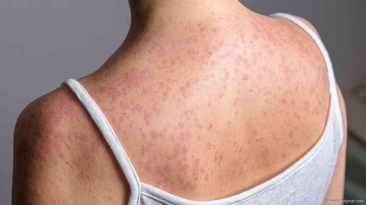 Sixth measles-associated death recorded in America as outbreak spirals... and death toll hits worst tally in 35 years