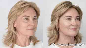 Anthea Turner, 66, shows off the results of her non-surgical facelift in a before and after shoot