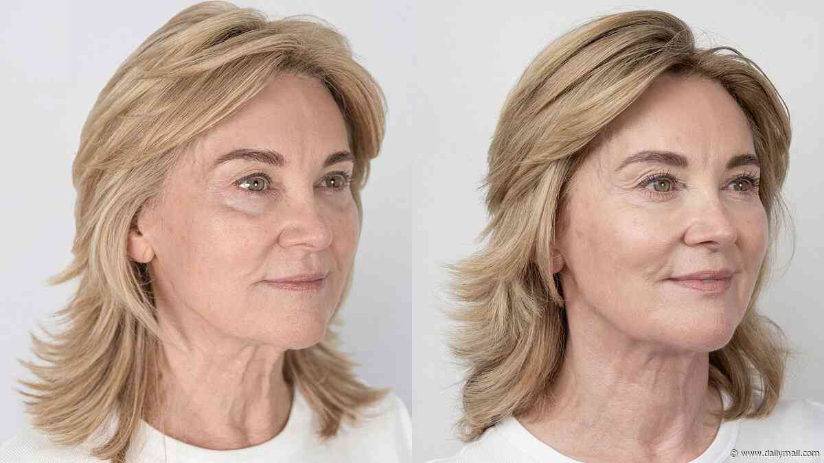 Anthea Turner, 66, shows off the results of her non-surgical facelift in a before-and-after shoot