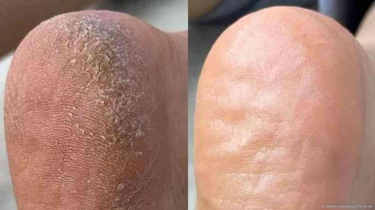 'My feet are no longer hobbit feet' after £36 pedicure set made them 'new'