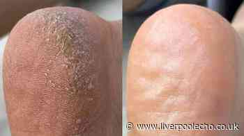 'My feet are no longer hobbit feet' after £36 pedicure set made them 'new'