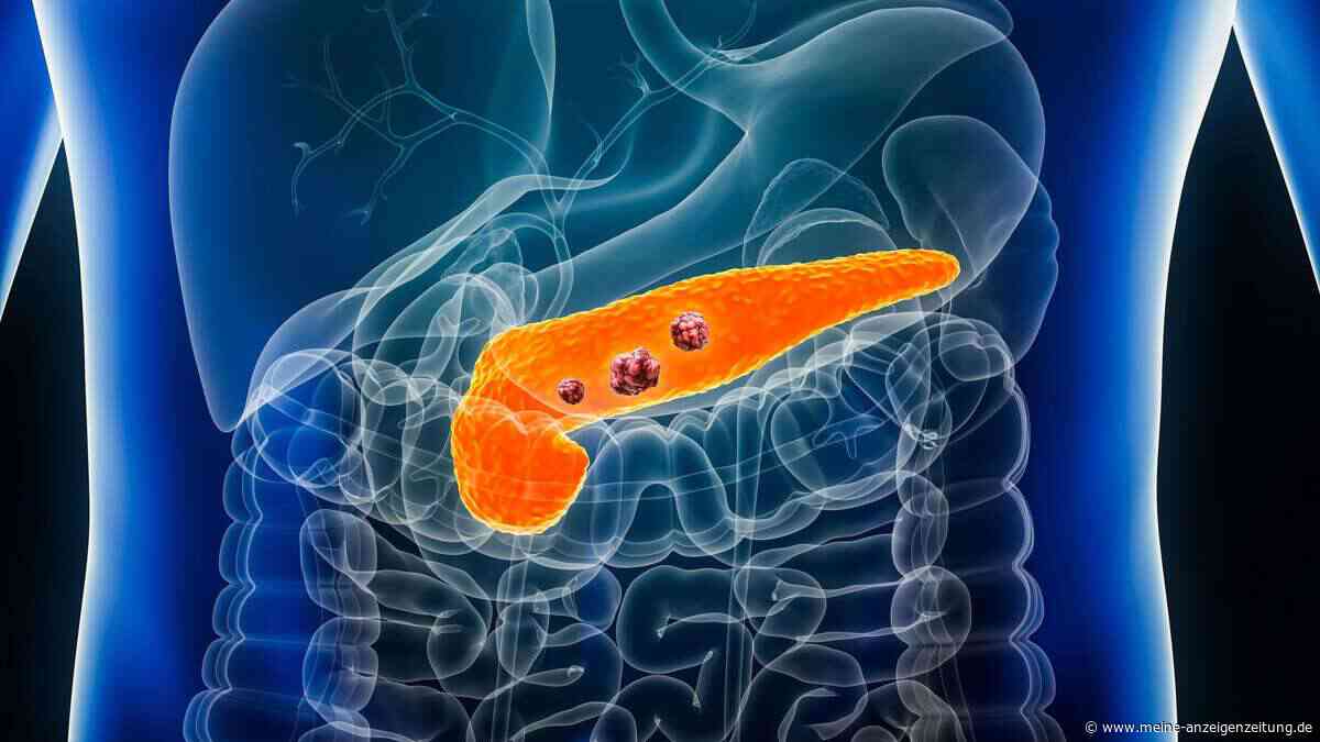 Neue Hoffnung bei Bauchspeicheldrüsenkrebs: Gen-Editierung soll Therapieresistenzen brechen
