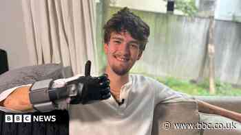 Meningitis survivor finally gets prosthetic hand
