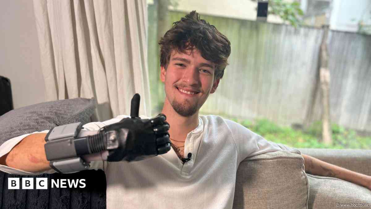 Meningitis survivor finally gets prosthetic hand