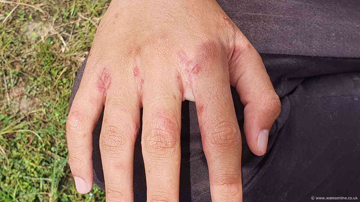 Scabies outbreak at Welsh hospital sees visits restricted