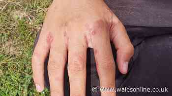 Scabies outbreak at Welsh hospital sees visits halted
