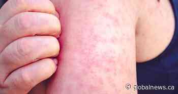 Manitoba declares measles outbreak over after weeks without cases
