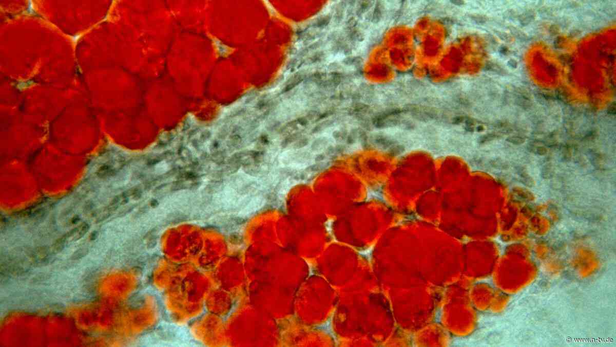 Alternative zu Ozempic & Co.?: Neue Spritze soll Fettzellen gezielt absterben lassen