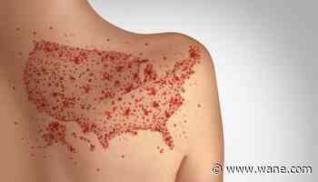 Measles cases rise in Adams County