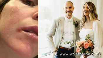 Mum who 'couldn't kiss husband at wedding' finds cold sore relief with 'miracle' £10 balm