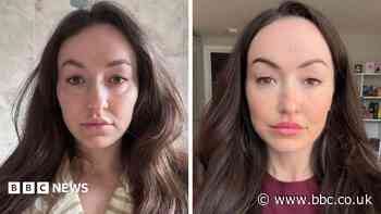 Is 'ferritin face' a real thing - and can you really spot low iron from looks?