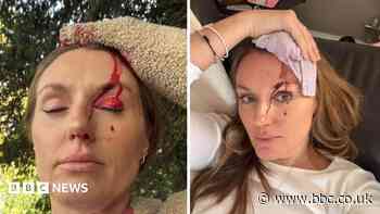 Woman hit by falling tree trunk 'lucky to be alive'
